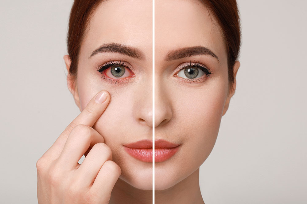 pink eye conjunctivitis treatment
