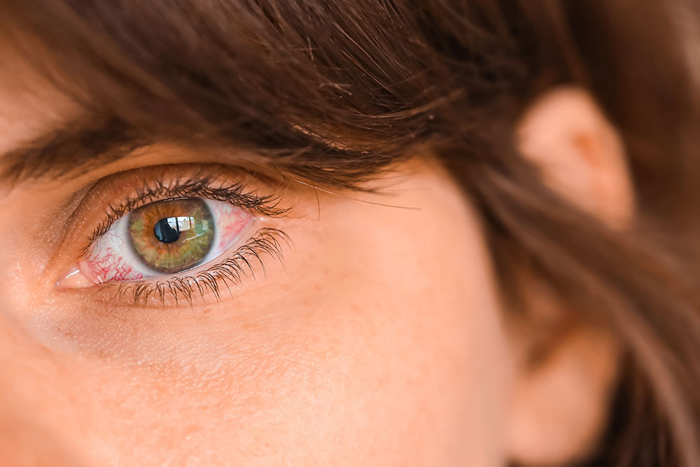 red eye evaluation and treatment